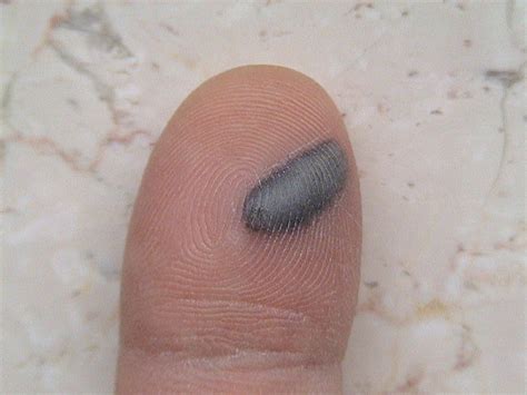 Blood Blisters Causes Symptoms Treatment Pictures Prevention