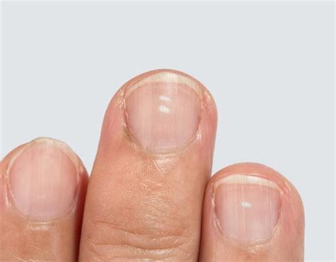 The 6 Most Common Nail Diseases Dino System