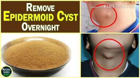 amazing home remedy to remove cysts and grease bail forever in just 7 days youtube