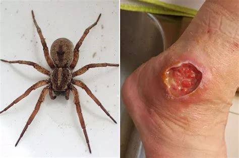 Stomach Churning Clip Shows Massive Spider Bite Becomes A Volcano Of