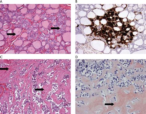 A Microscopic View Of Normal Thyroid Tissue With Hyperplastic C Cells