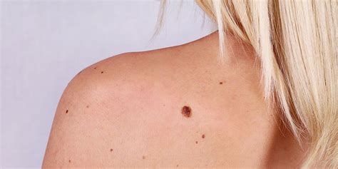 Skin Cancer Surprising Causes Womens Health