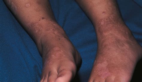Treatment Of Linear Iga Bullous Dermatosis Of Childhood With