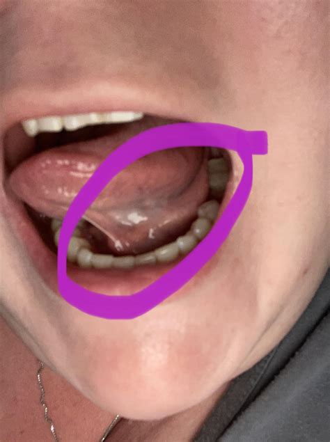 Swollen Under The Left Side Of My Tongue What Is This And Is There