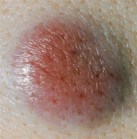 Skin Cancer Symptoms Signs Types Treatments And Prevention