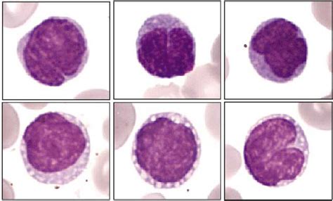 The prognosis is generally poor. Peripheral blood smears (May-Gru ̈ nwald Giemsa stain, G Â ...