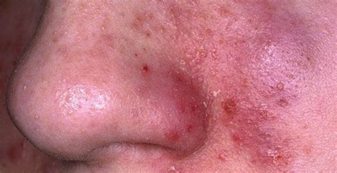 Health Problems Caused By Vulgaris Acne About Health Problems