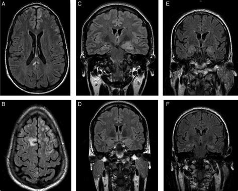 Patients Brain Mri Scans A And B Flair Sequence Of The First
