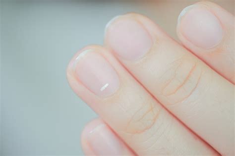 White Spots On Finger Nails Called Leukonychia Reveal The Emergence Of