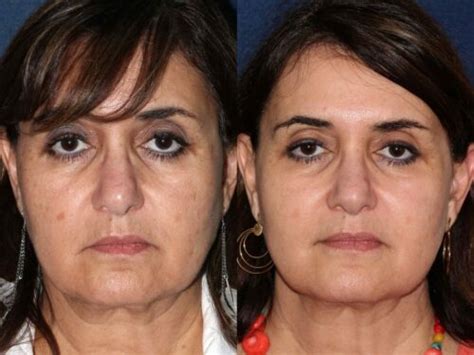 Sunken Cheeks Causes And Treatments Cosmetic Laser Dermatology Skin