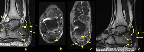 Postoperative Infection Of The Achilles Tendon Insertion After Surgery