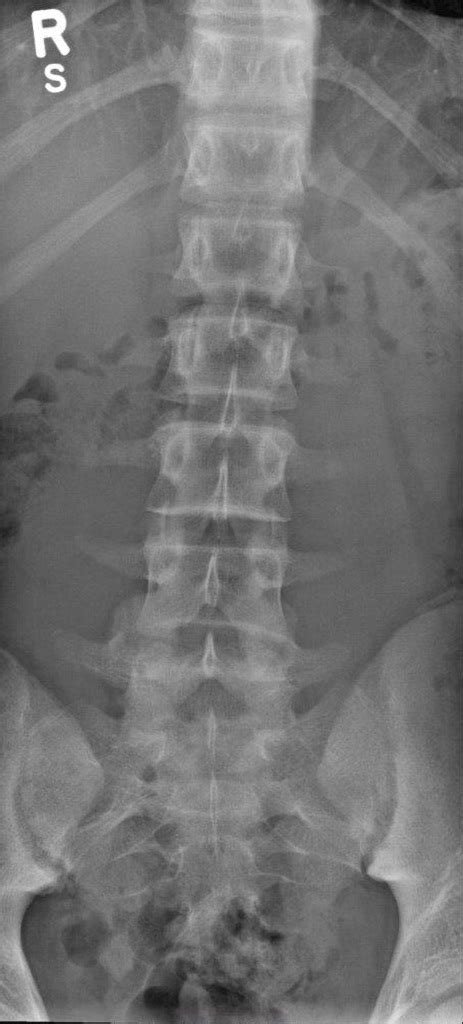 Lumbar Spine Xray