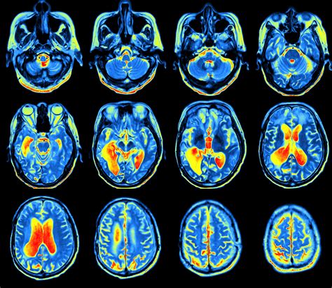 Imaging Tracer With Potential To Bolster Parkinsons Clinical Trials