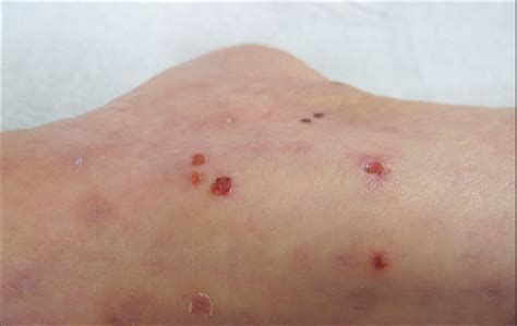 Eosinophilic Dermatoses Exaggerated Insect Bite Like Reaction