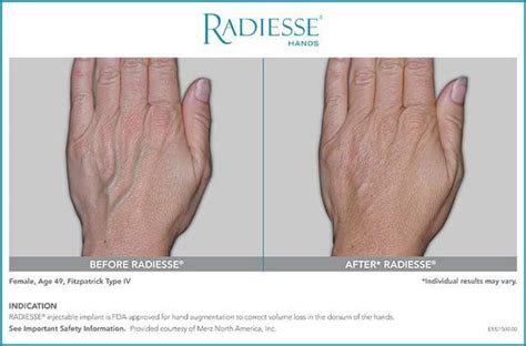 Radiesse Hand Rejuvenation Md Age Management