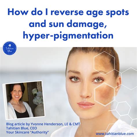 How Do I Reverse Age Spots And Sun Damage Aka Hyper Pigmentation