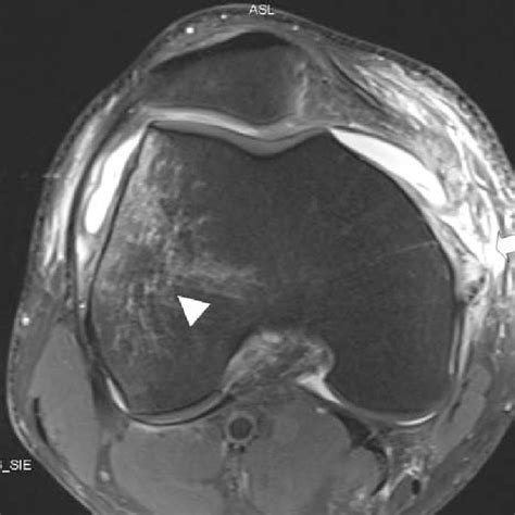 A Transverse T2 Weighted Fast Spin Echo Mri Of The Knee Obtained At