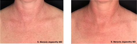 Chicken Skin Neck Laxity Is Erased After 1 Session Injectable Prp