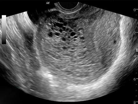 Complete Hydatidiform Mole Radiology Reference Article Radiopaedia Org