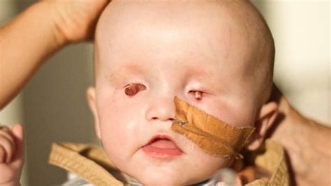 Baby Born Without Eyes Gofundme Campaign Is Trending For Archie