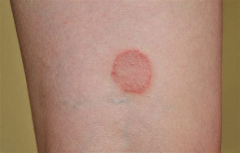 Symptoms And Treatments Of Tinea Cruris Facty Health