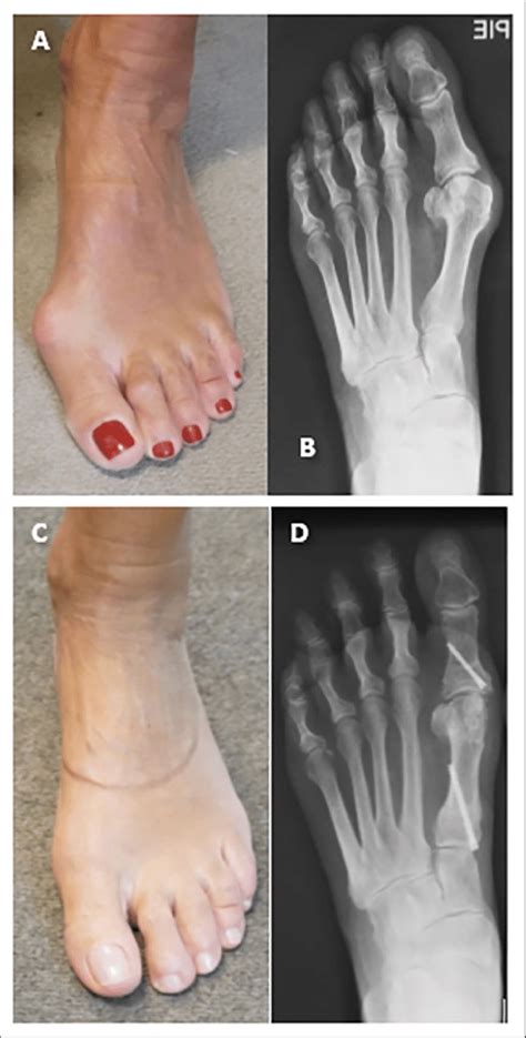 A B Preoperative Clinical And Radiograph Showing Moderate Hallux