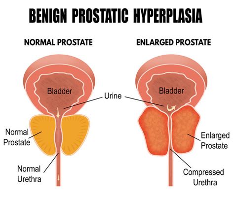 Prostatahyperplasie Apothekenwiki