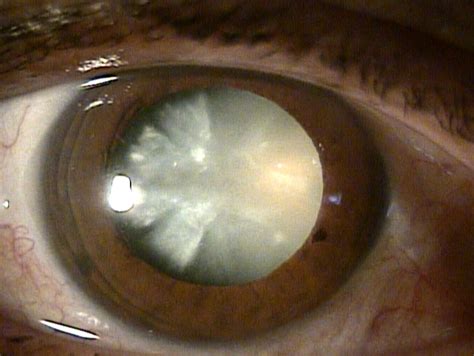 Dense Cataract Comprehensive Guide On This Type Of Cataract