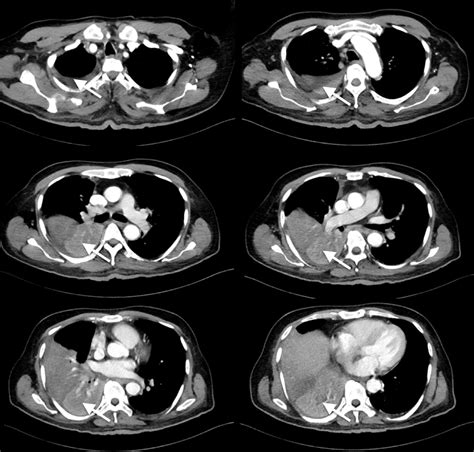 Cureus A Rare Case Of A Massive Food Bolus Mimicking Lung Cancer