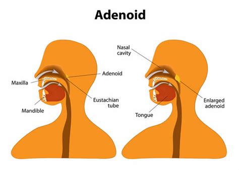 What Is An Adenoidectomy Or Adenoid Removal And How Does It Help
