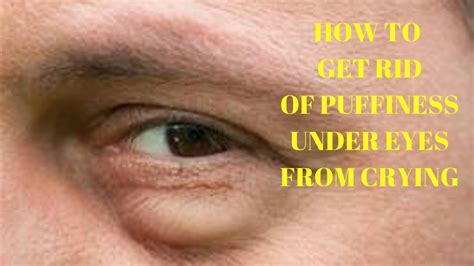 How To Get Rid Of Puffiness Under Eyes From Crying Youtube