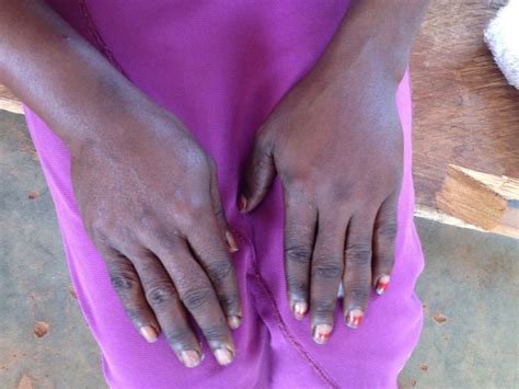 Loiasis Loa Loa Death To Onchocerciasis And Lymphatic Filariasis