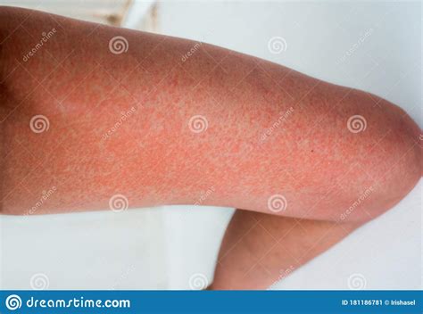 Severe Sunburn Summer Tan Poor Sun Protection Sun Allergies