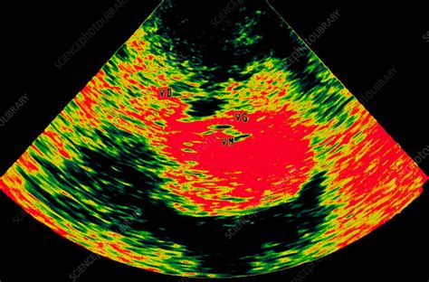 Heart Defect Ultrasound Scan Stock Image M1720626 Science Photo