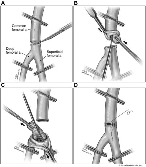 Experience With Eversion Endarterectomy Of The Common Femoral Artery
