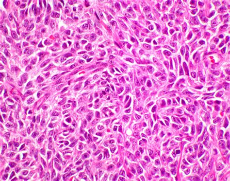 Pathology Outlines Adult Granulosa Cell Tumor