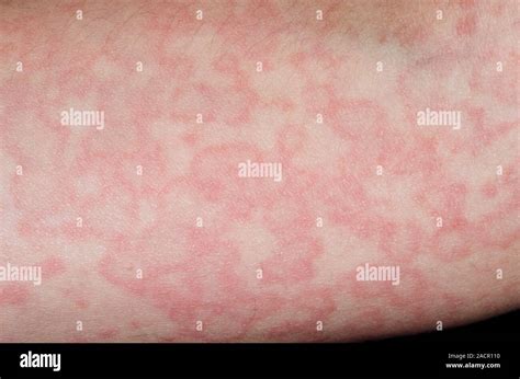 Rash Of Red Wheals On The Skin Of An 11 Year Old Male Patient An