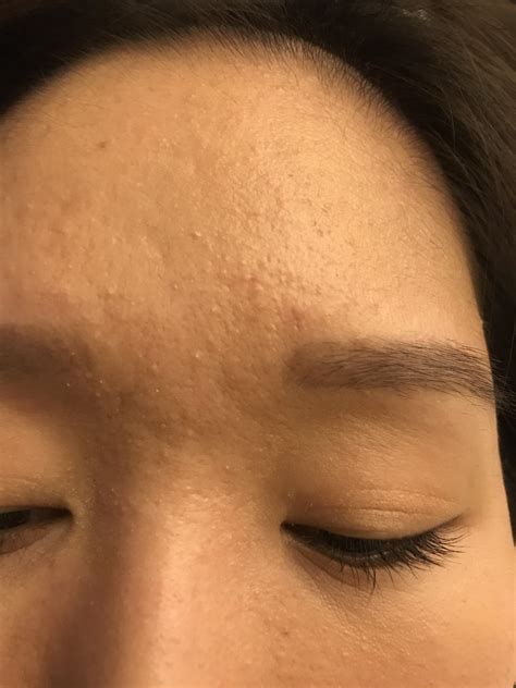 ACNE Are These Clogged Pores Or Closed Comedones Even After Foundation You Can See Bumps