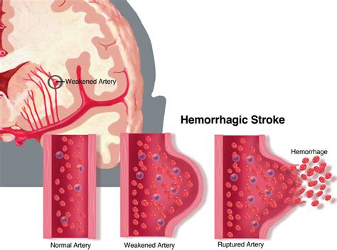 Age, size of infarct, prognosis ▪ encourage neurology partners to participate in. Stroke - Basic Science - Orthobullets