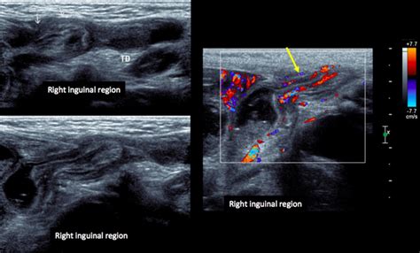 Right Indirect Inguinal Hernia With A Nonreducible Small Bowel Segment
