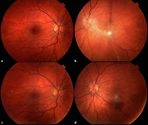 Color Fundus Photographs Of The Right And Left Eyes Preoperatively And