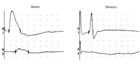 Left Median Nerve Conduction Studies In Patient 4 A1 Stimulation At