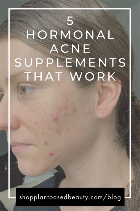 5 Best Hormonal Cystic Acne Supplements That Actually Work — Plant Based Beauty Hormonal