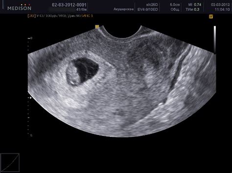 Echographie à 4 Semaines De Gestation 26 Photos Taille Du Fœtus Est