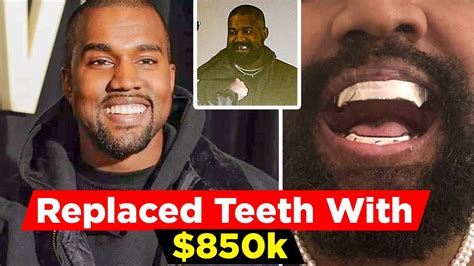Kanye West Replaced His Teeth With 850k James Bond Inspired Titanium