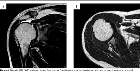 Figure 4 From Magnetic Resonance Imaging Of Rotator Cuff Tears In