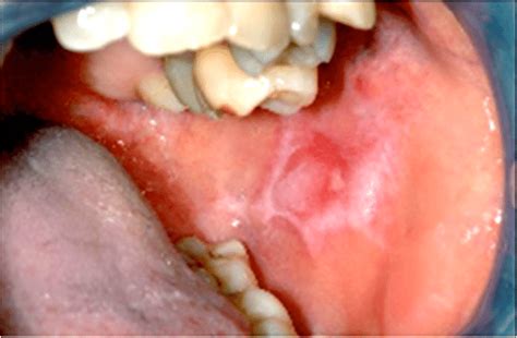 Oral Lichenoid Lesion Observed On Left Buccal Mucosa Download