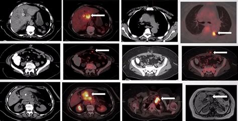 Cureus 18f Fdg Petct Imaging Of Gallbladder Adenocarcinoma A