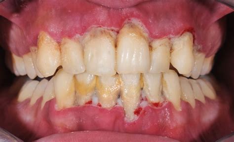 Calcium Deposits On Teeth Causes Treatment And Prevention