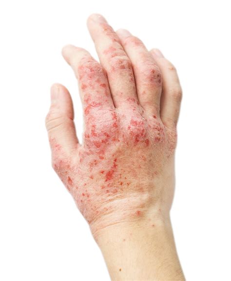 Pictures Of Eczema Contact Dermatitis Pictures